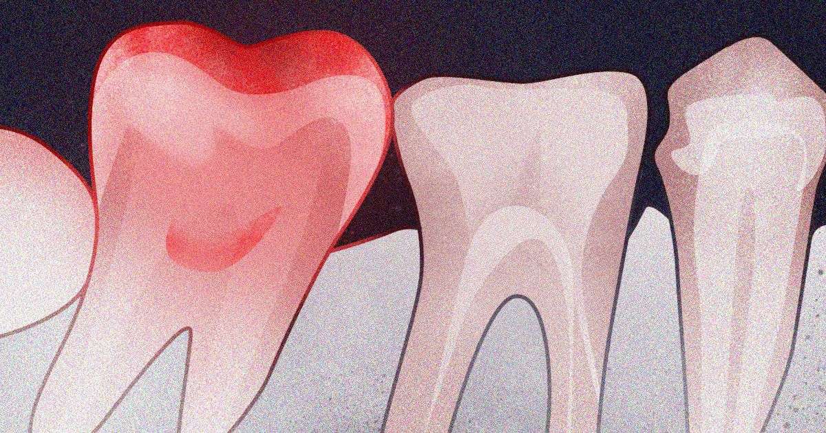 10 signs of toxic tooth infection and how to treat it at home