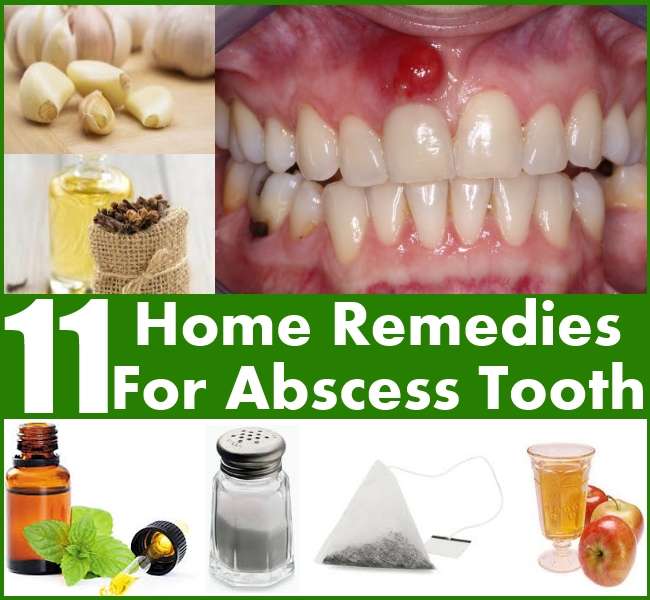 11 Home Remedies For Abscess Tooth