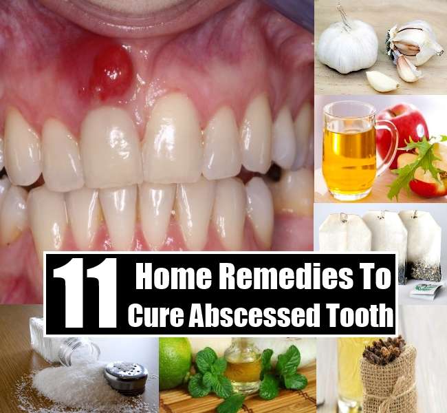 11 Home Remedies To Cure Abscessed Tooth