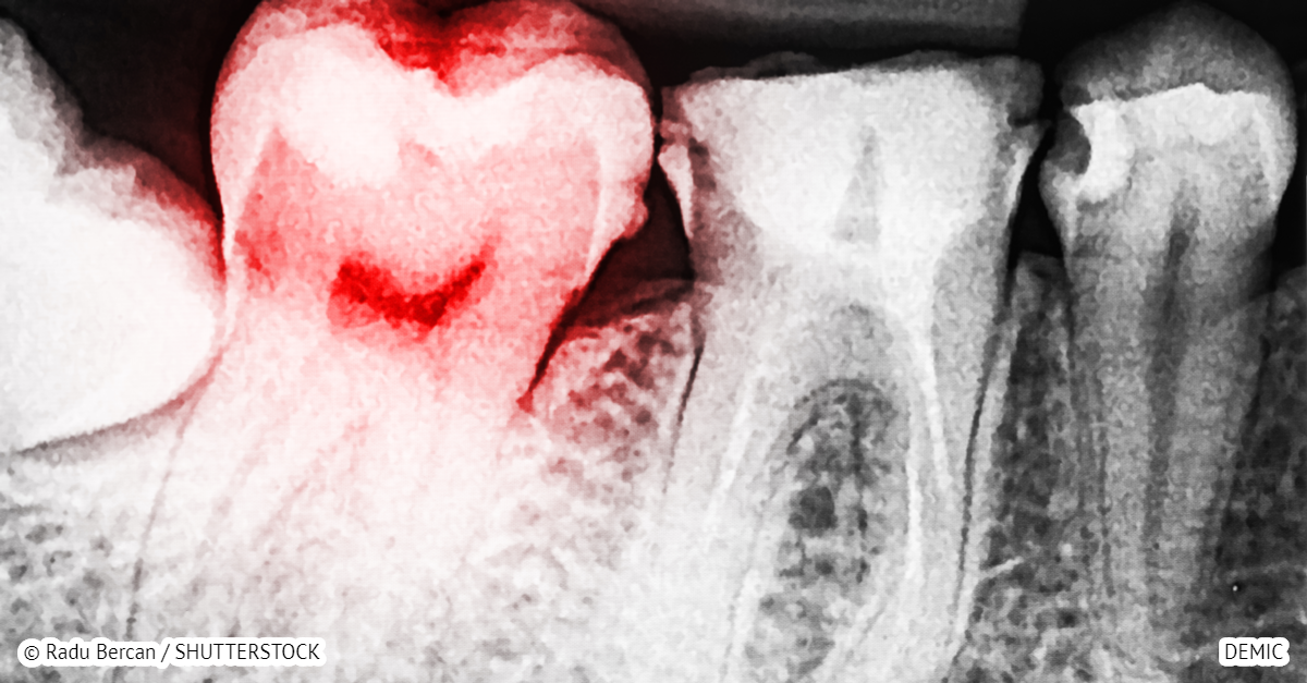 13 signs you have a toxic tooth infection and how to treat ...