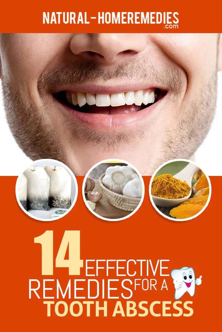 14 Effective Remedies For A Tooth Abscess â Natural Home Remedies ...