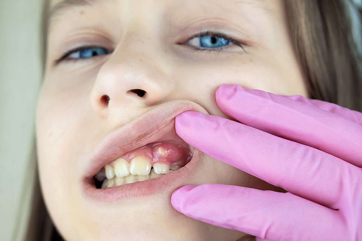 3 Signs of an Abscessed Tooth