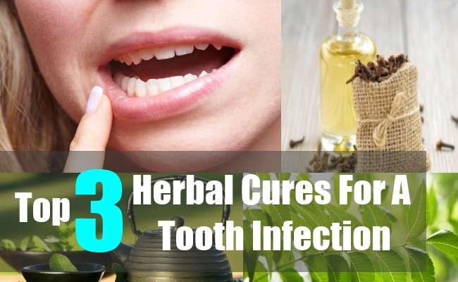3 Tooth Infection Natural Home Remedies