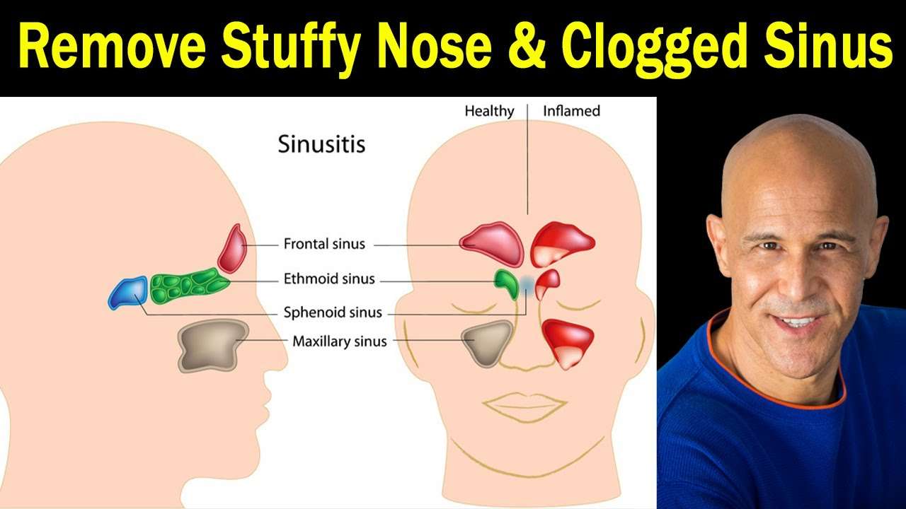 4 Proven Techniques for Stuffy Nose &  Clogged Sinus