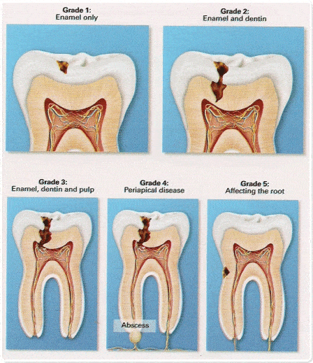 # 53 Human teeth and dental decay