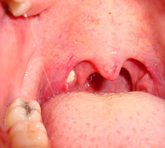 6 Alarming Symptoms Of Tonsilloliths That Should Never Be Ignored
