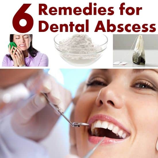 6 Natural Home Remedies for Dental Abscess