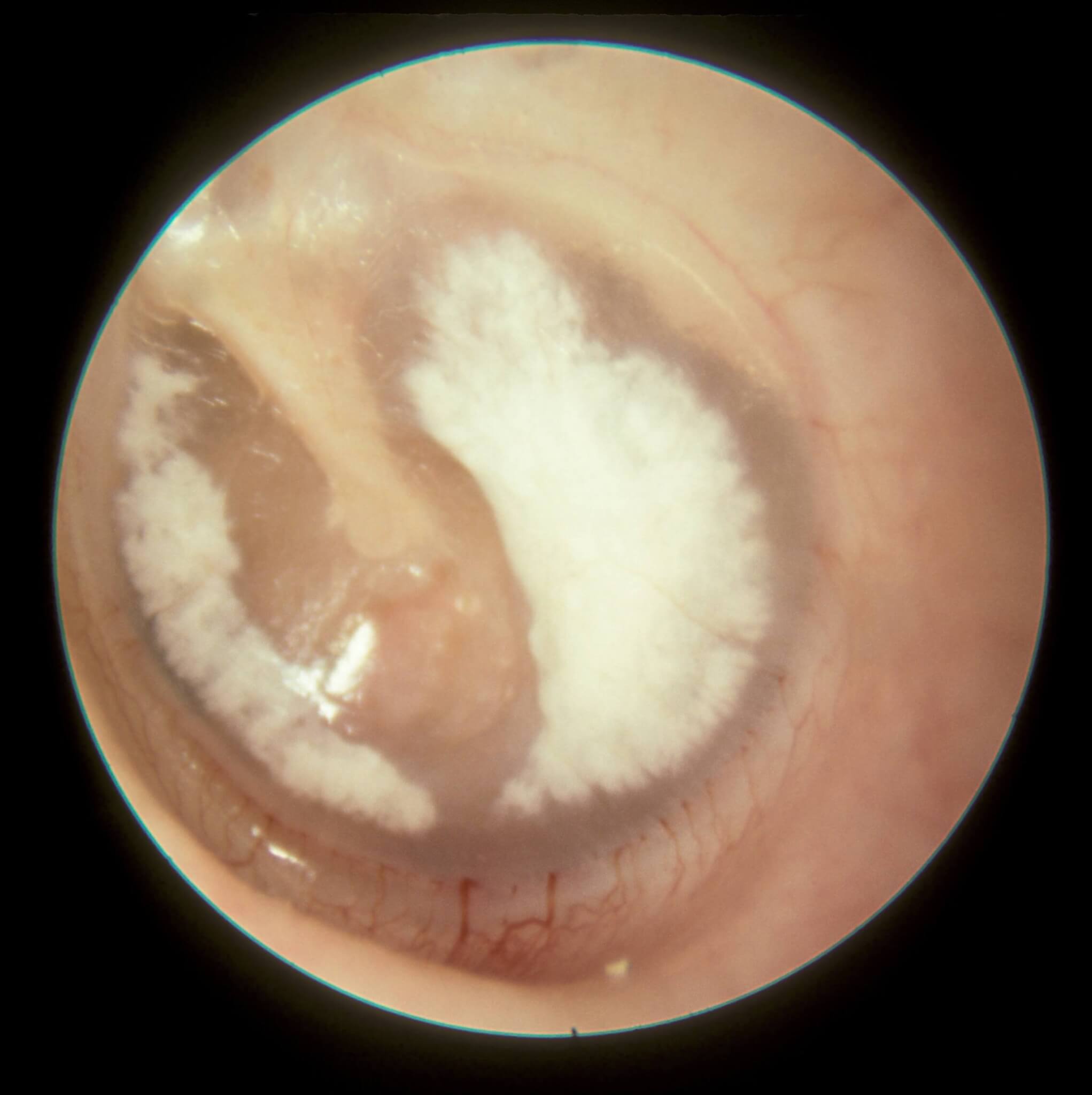 7 Undesirable Ear Tube Complications (which may require more surgery ...