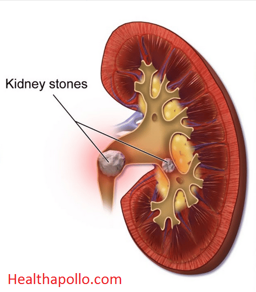 9 home based remedies for Kidney Stone for fast result