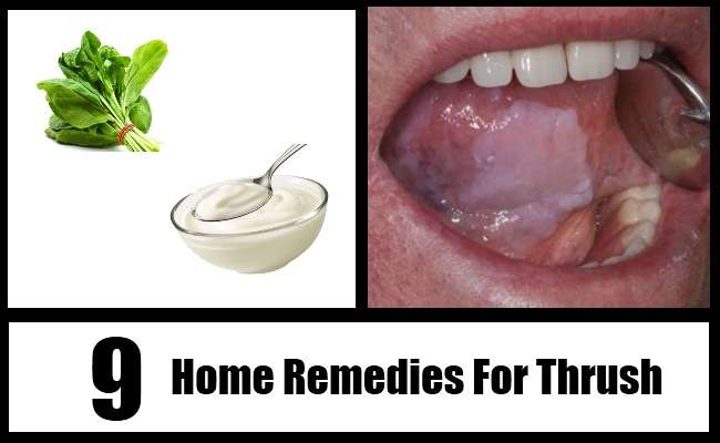 9 Thrush Home Remedies