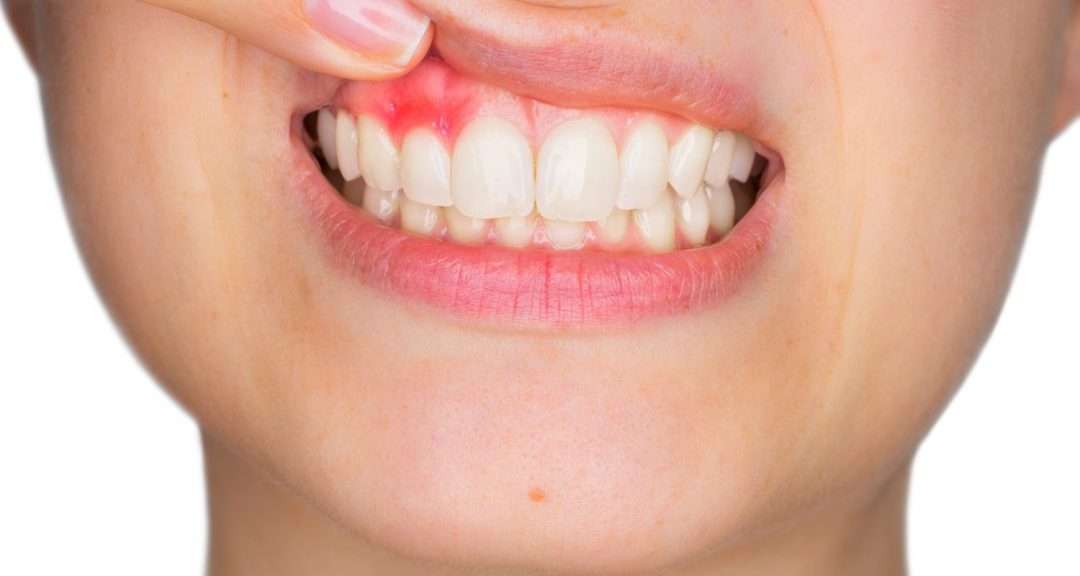 A Guide to Dental Abscesses