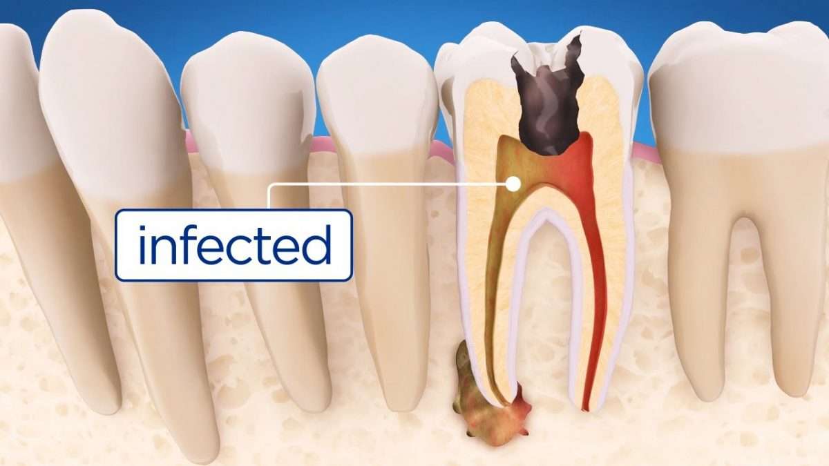 A Root Canal from A Manila Dental Clinic: What Is It?  Asian Sun ...