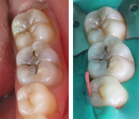 A tooth hurts under the filling after filling the canals: what to do?