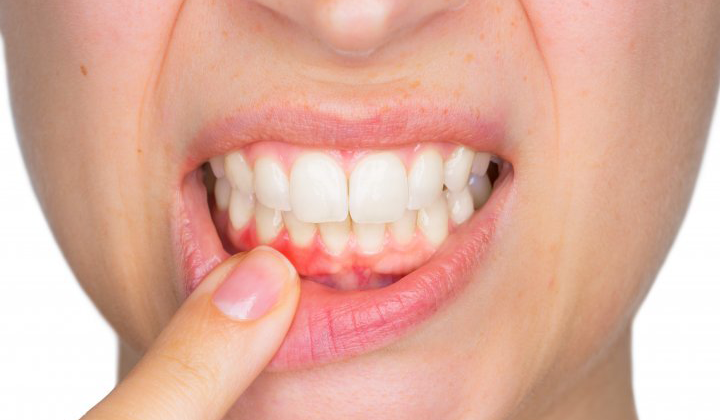 A Tooth Infection Can Spread to Your Body?