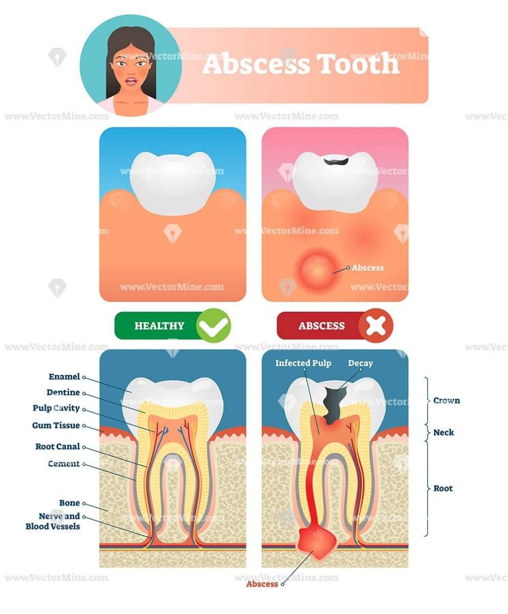 Abscess tooth vector illustration medical diagram poster