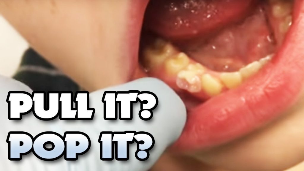 Abscess Tooth When To Go To The Emergency Room