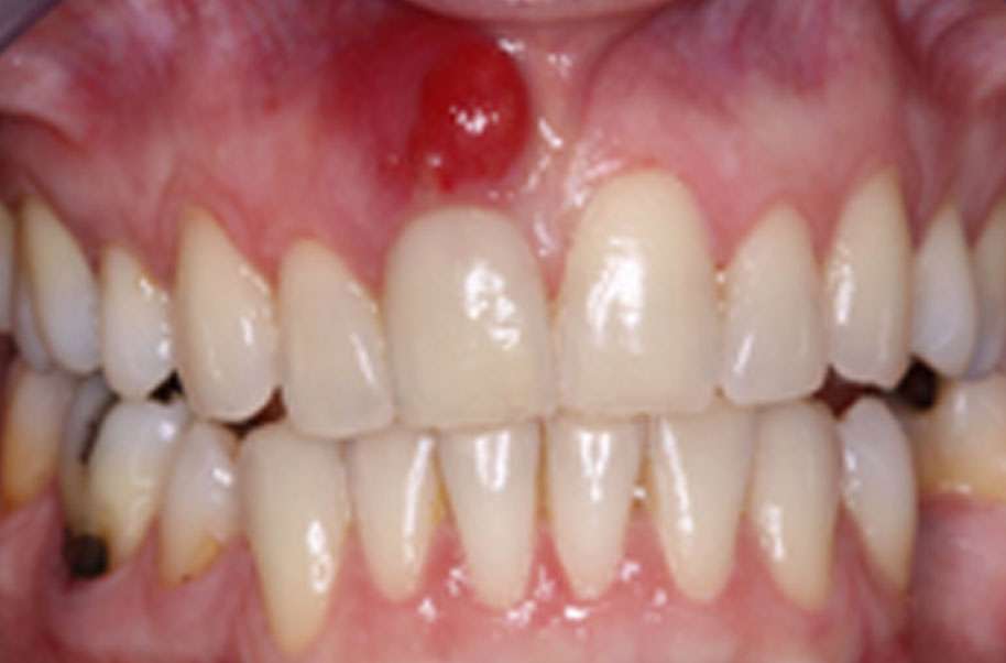 Abscessed Tooth Guide