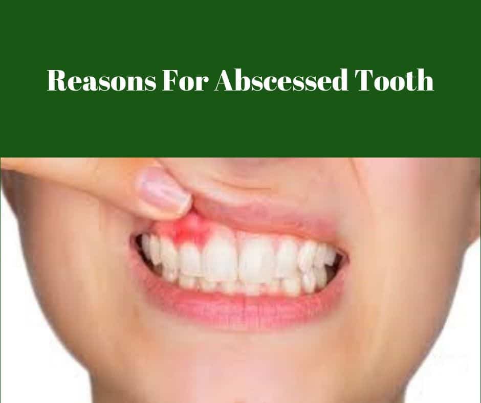 Abscessed Tooth Reasons And How To Get Rid Off It?