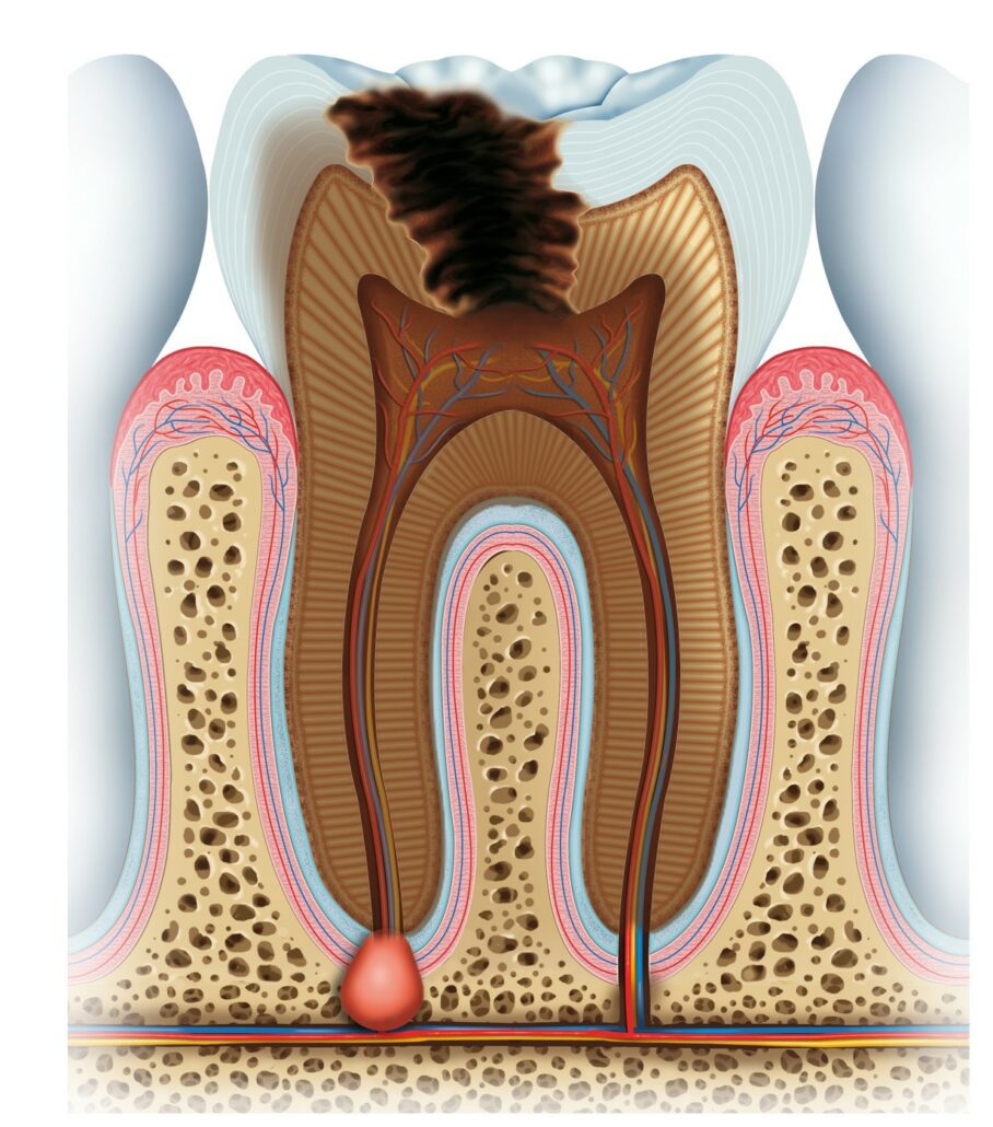 Abscessed Tooth: Types, Symptoms, Causes, Treatment