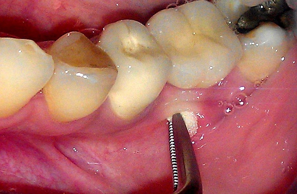 Abscessed Wisdom Tooth
