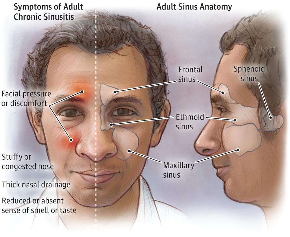 Adult Chronic Sinusitis