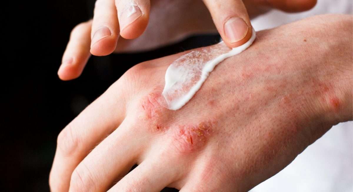Antibacterial treatment of skin infections