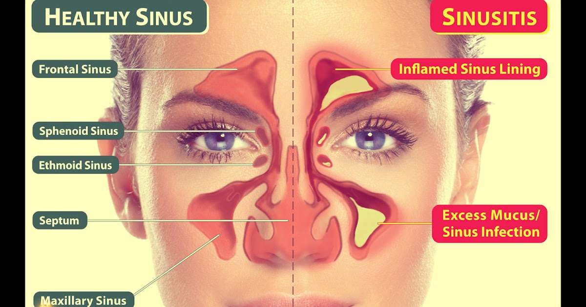 Are Sinus Infections Contagious Through Kissing