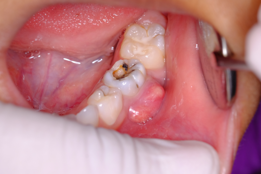 Baby tooth with Abscess