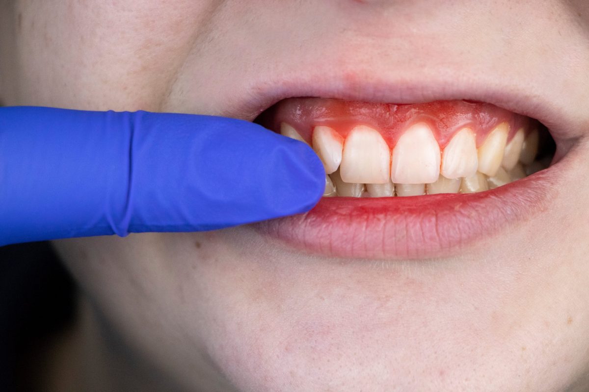 Be Aware Of These Periodontal Disease Dangers : Garran Dental Woden