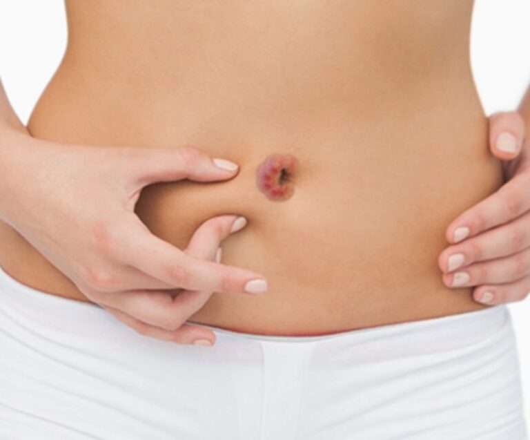 Belly Button Discharge â Causes, Yeast, Smelly White, Brown, Yellow ...