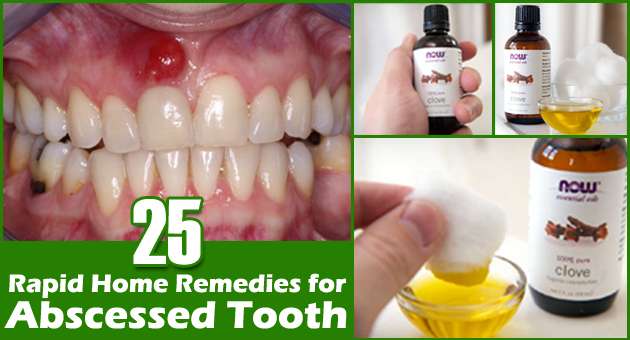 Best Home Remedies for Abscessed Tooth