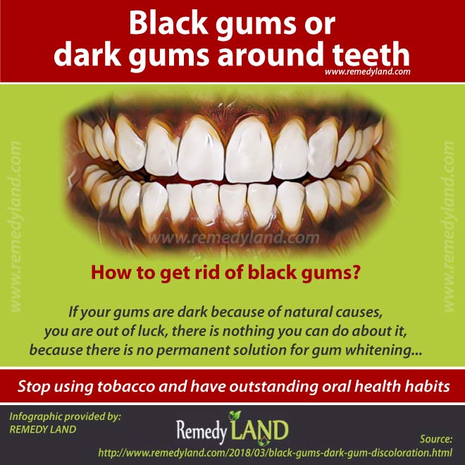 Black gums or dark gums around teeth : Gum discoloration