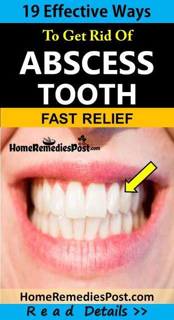 Can An Abscessed Tooth Cause A Headache