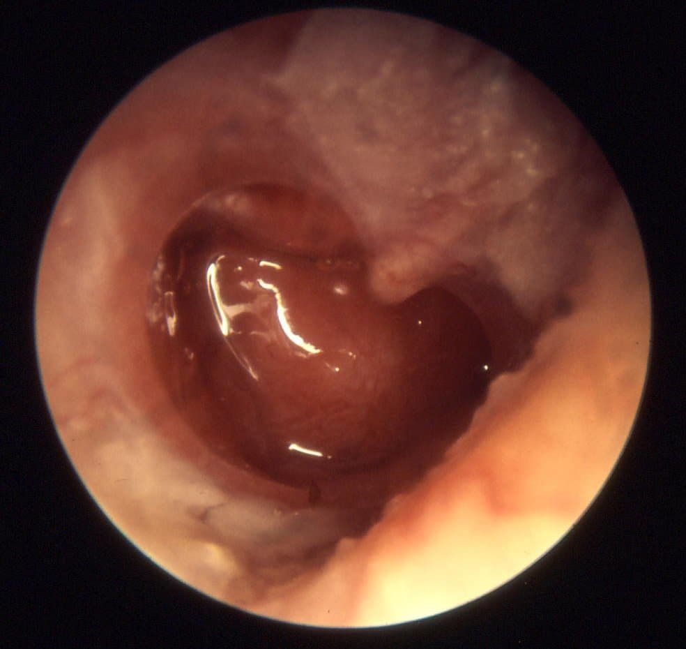 Can Otitis Externa Cause Hearing Loss