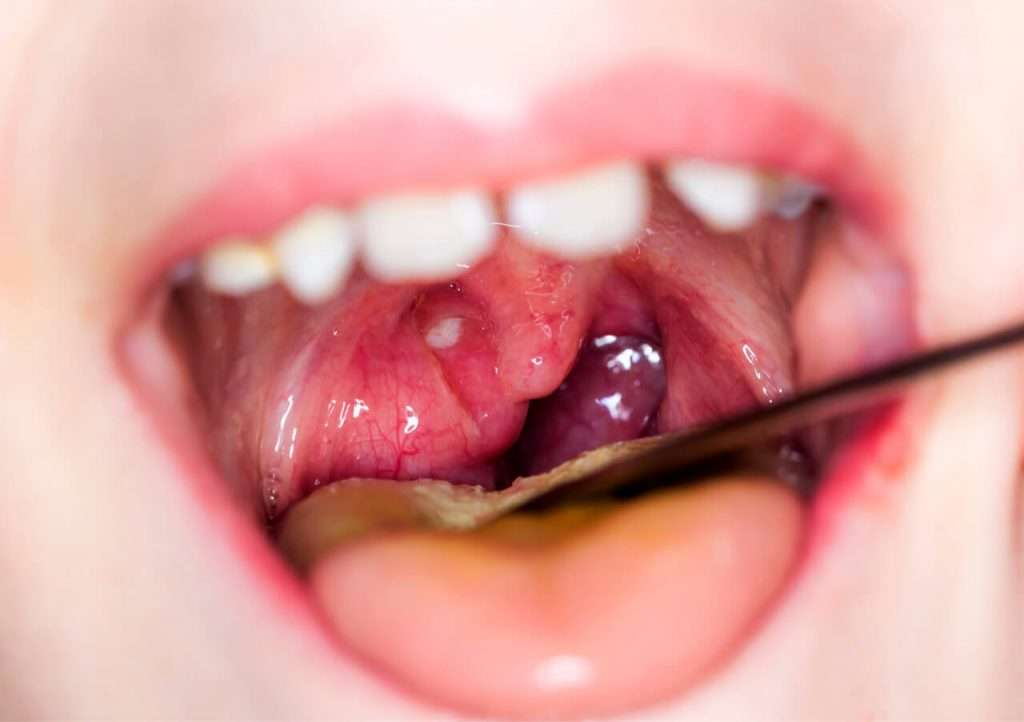 Can Wisdom Teeth Cause Sore Throat  Boston Dentist  Congress Dental ...