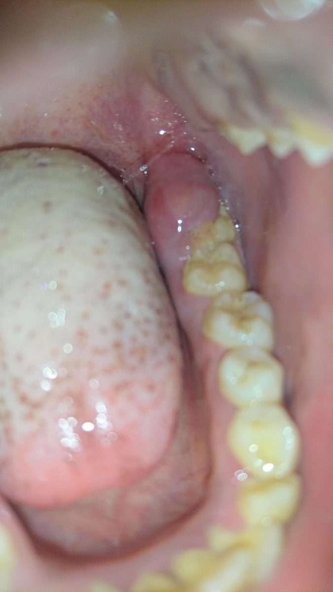 Can Wisdom Teeth Cause Tonsils To Swell