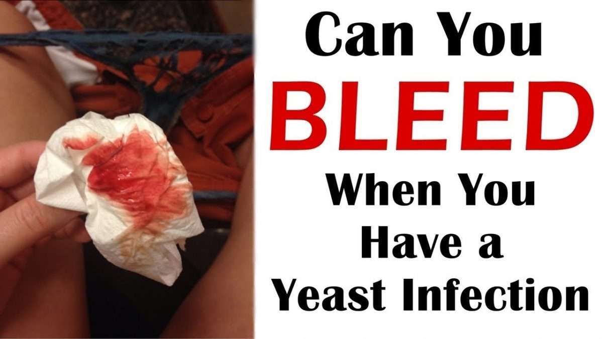 Can You Bleed When You Have a Yeast Infection