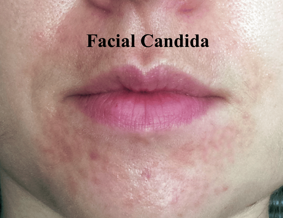 Candida of the skin: facial yeast and how it can occur