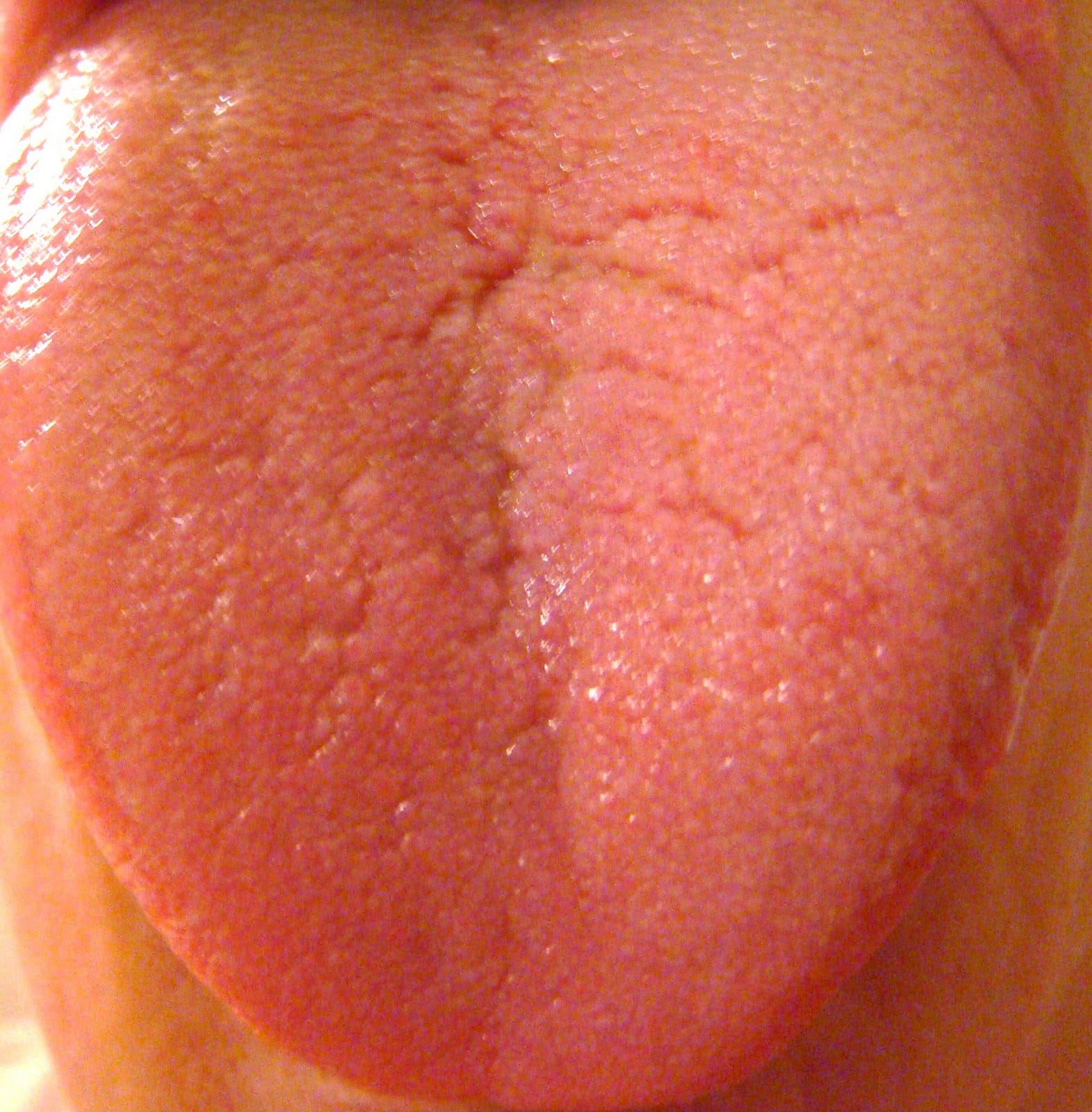 Causas de candidiasis oral en adultos, sore tongue candida die off ...