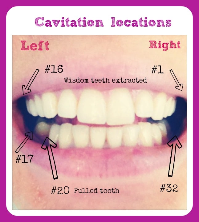 Cavitations: chronic illness that stems from the jaw