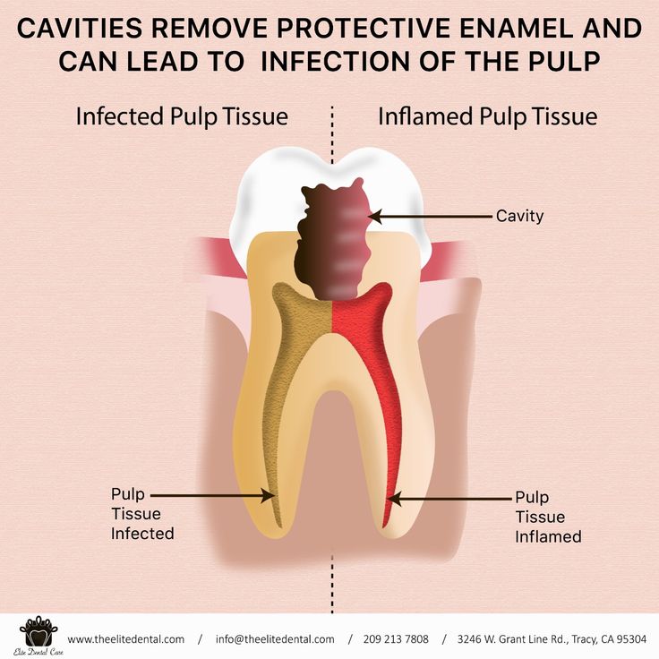 Cavities Remove Protective Enamel and Can Lead to Infection of The Pulp ...