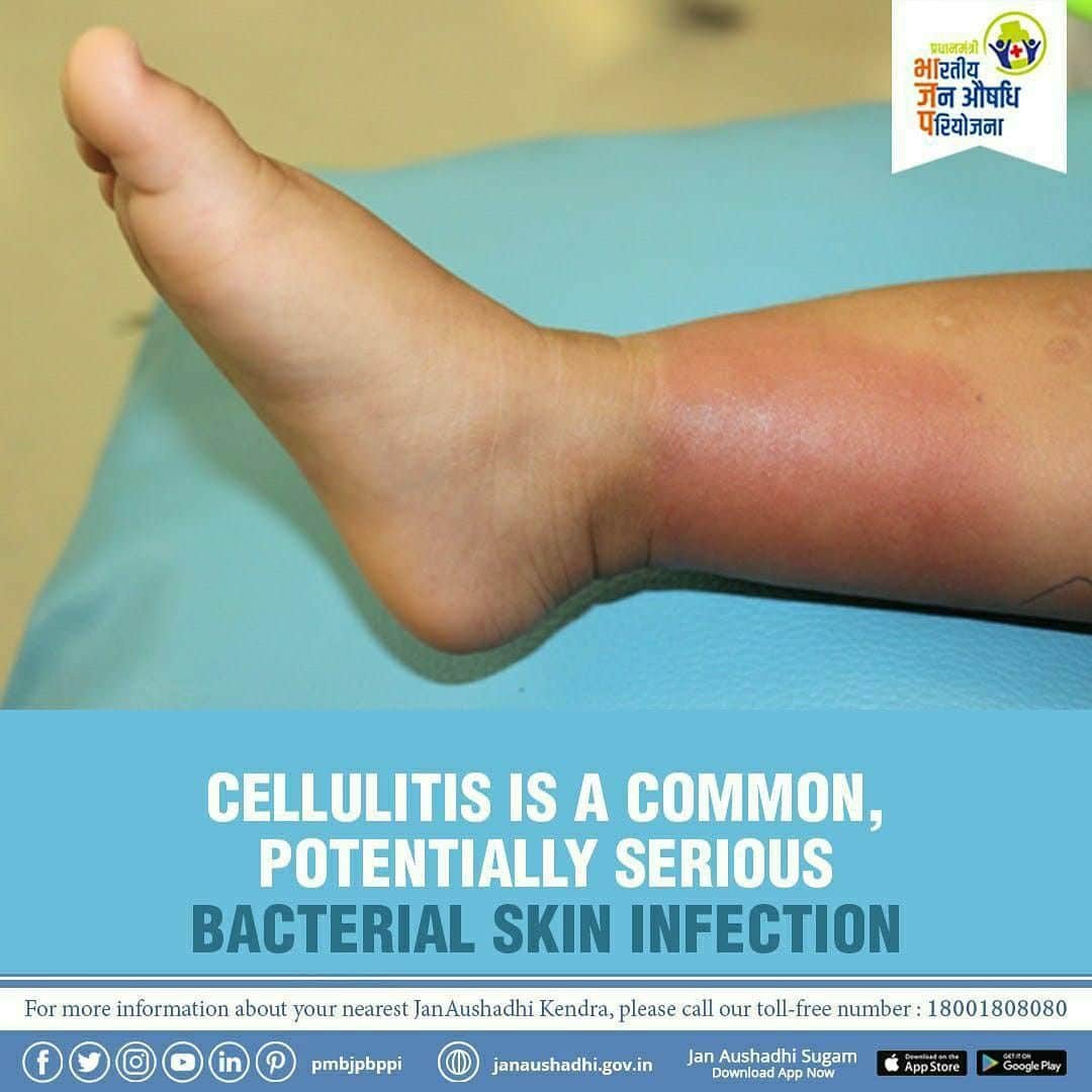 #Cellulitis is a bacterial infection involving the inner layers of the ...