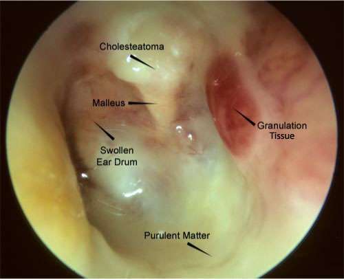 Chronic Ear Infection Images