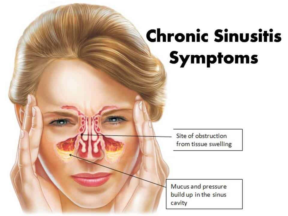 Chronic Sinusitis Symptoms and Treatments