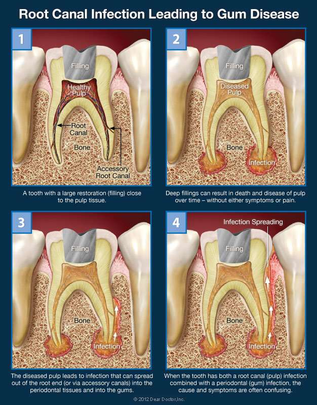 Combined Root Canal &  Gum Problems