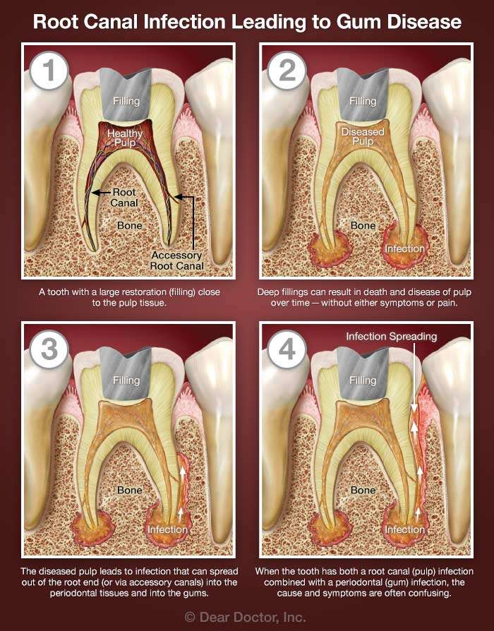 Combined Root Canal &  Gum Problems