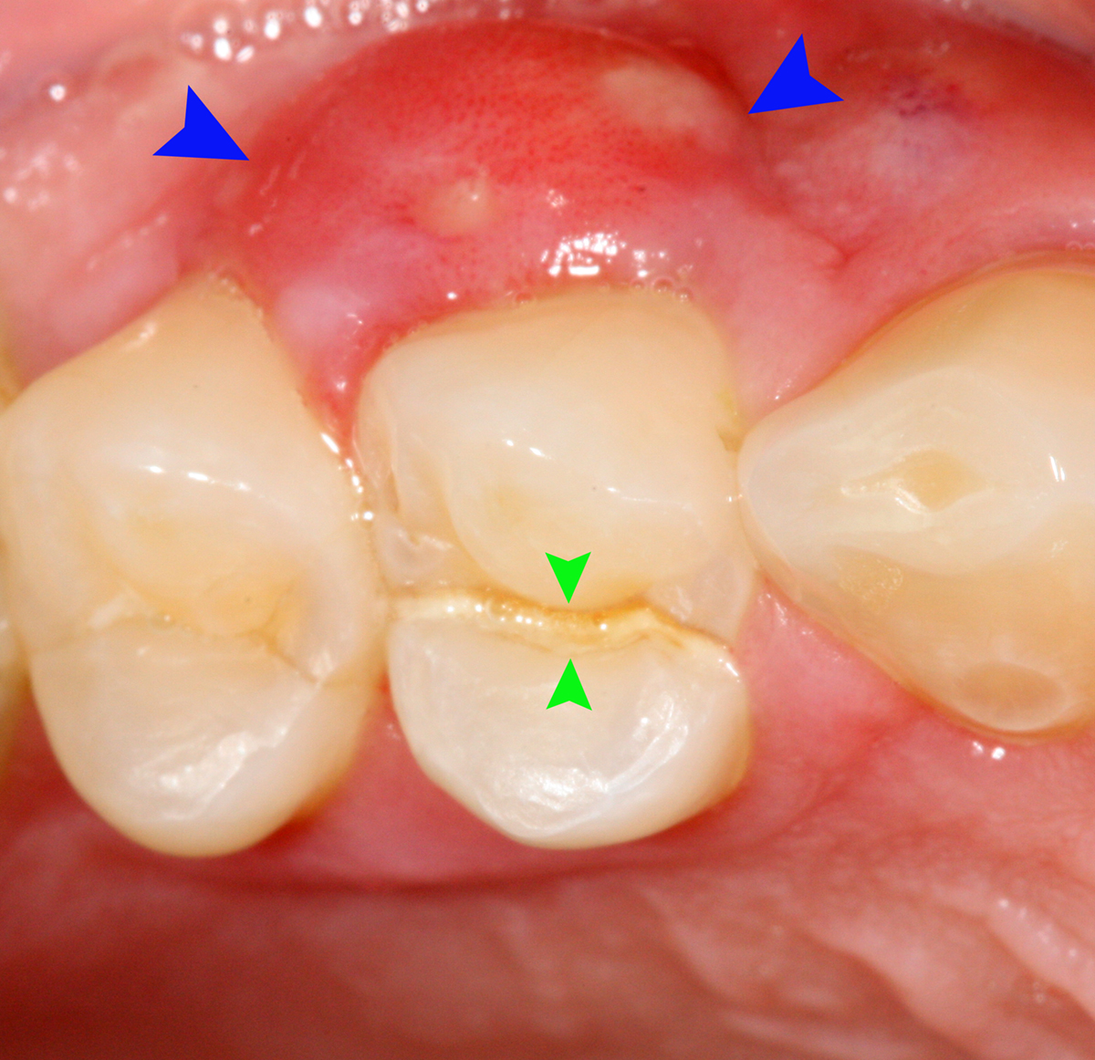 Complications of tooth abscess
