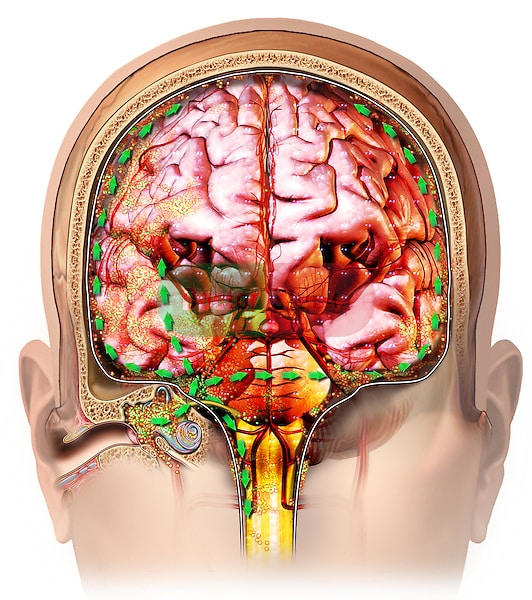 Coronal ear and brain anatomy with spread of bacterial meningiti ...