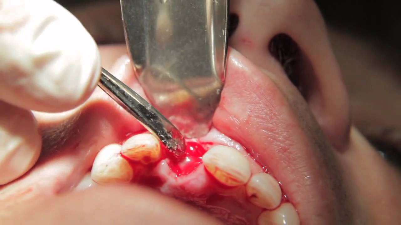 Cracked Tooth Extraction