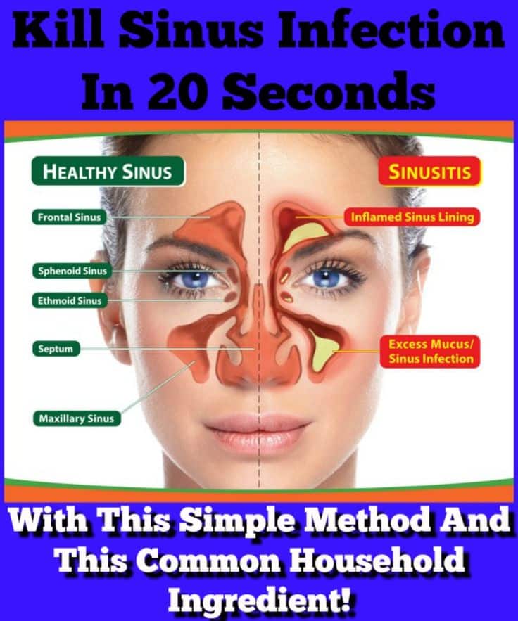 Cure Sinus Infection In A Few Seconds Using A Kitchen Ingredient